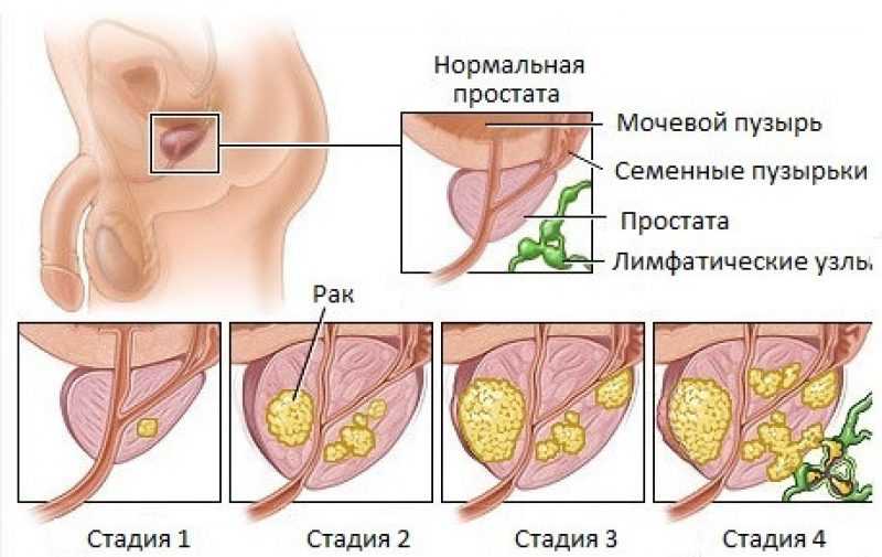 Первые признаки рака простаты, симптомы рака предстательной железы
