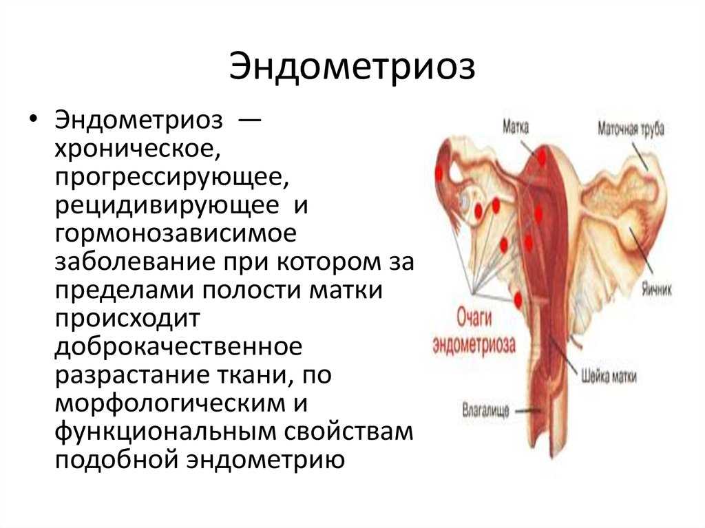 Эндометриоз – причины, симптомы и лечение