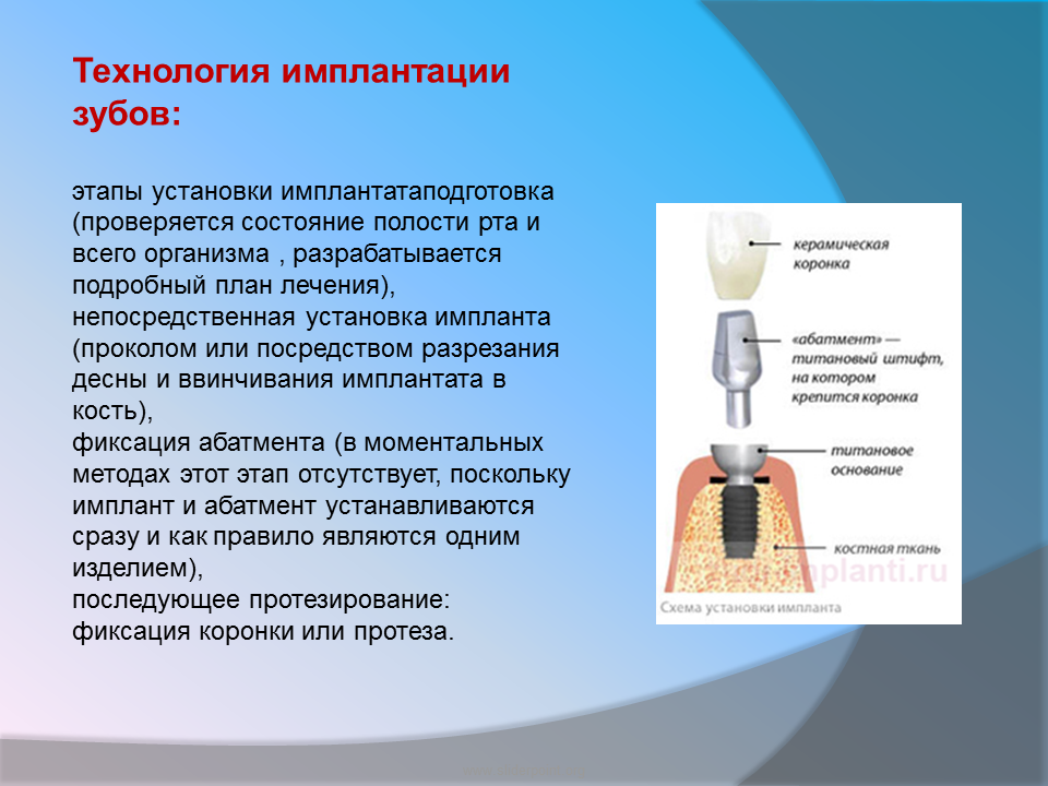 План лечения при имплантации зуба