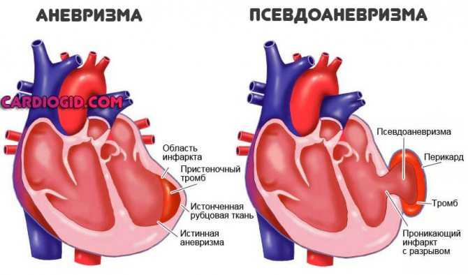 Сколько живут после инфаркта статистика