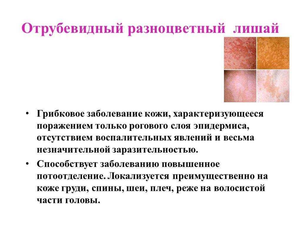 Стригущий лишай * клиника диана в санкт-петербурге