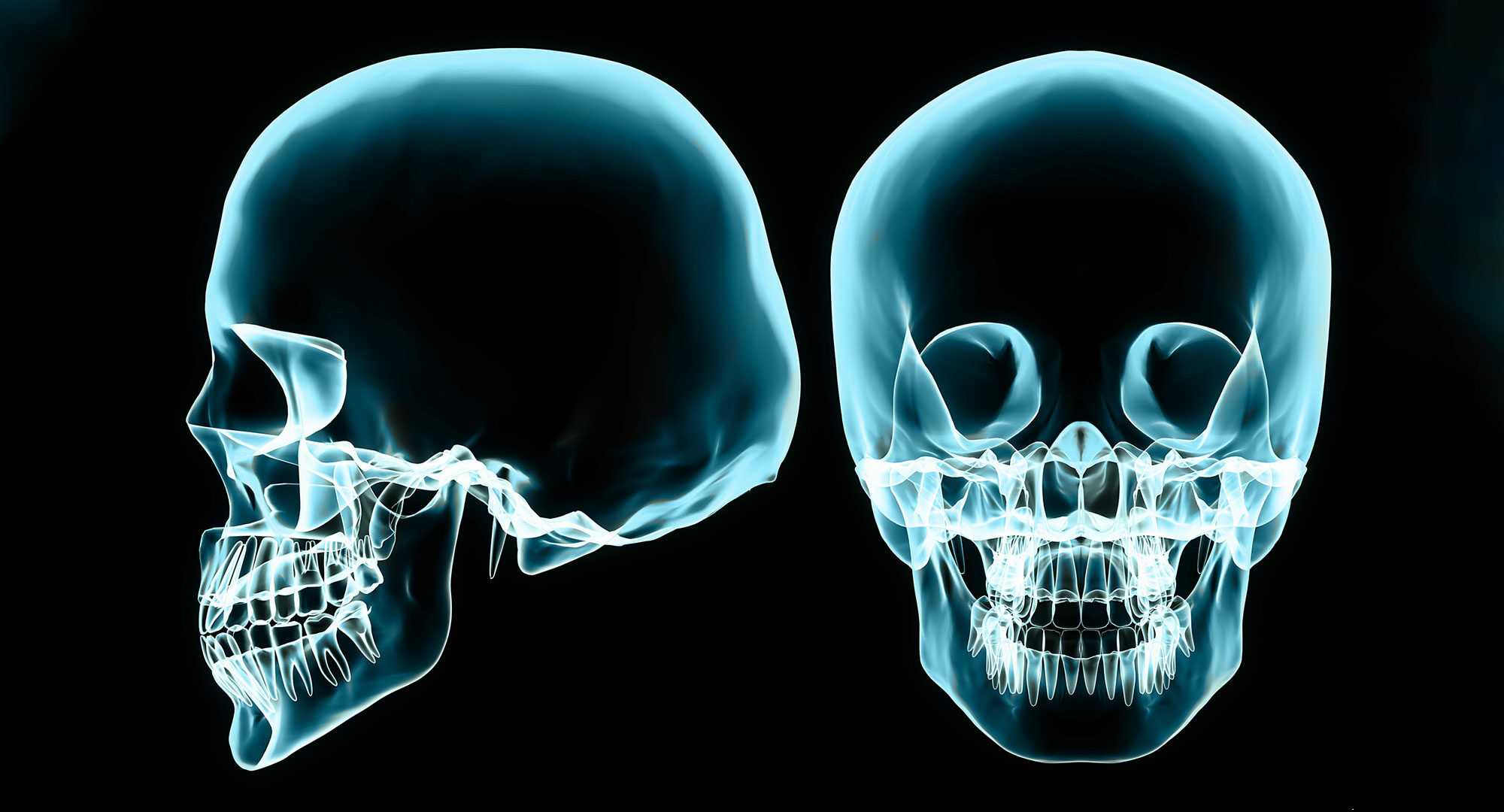 Рентген снимок черепа сбоку