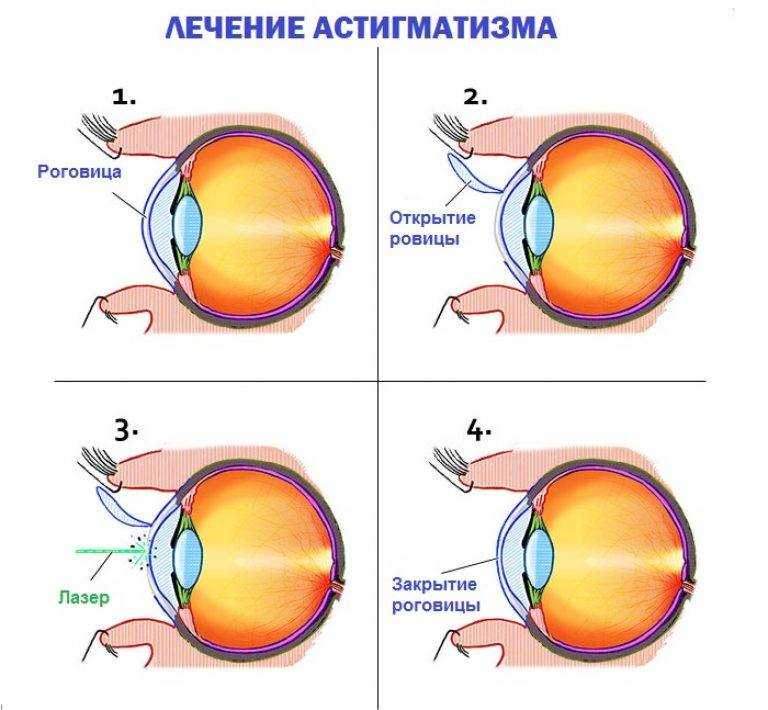 Миопия
