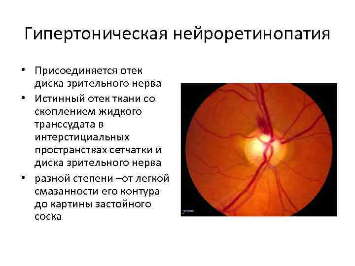 Расширение пространства зрительного нерва. Гипертоническая ангиопатия сетчатки глазное дно. Гипертоническая ретинопатия глазное дно. Офтальмоскопия диска зрительного нерва. Гипертоническая ангиопатия и ретинопатия.