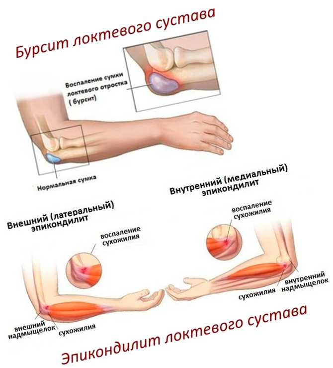 Лечение локтевого сустава симптомы. Медиальный эпикондилит сухожилия. Латеральный эпикондилит локтевого сустава. Внешний эпикондилит локтевого сустава. Медиальный надмыщелок локтевого.