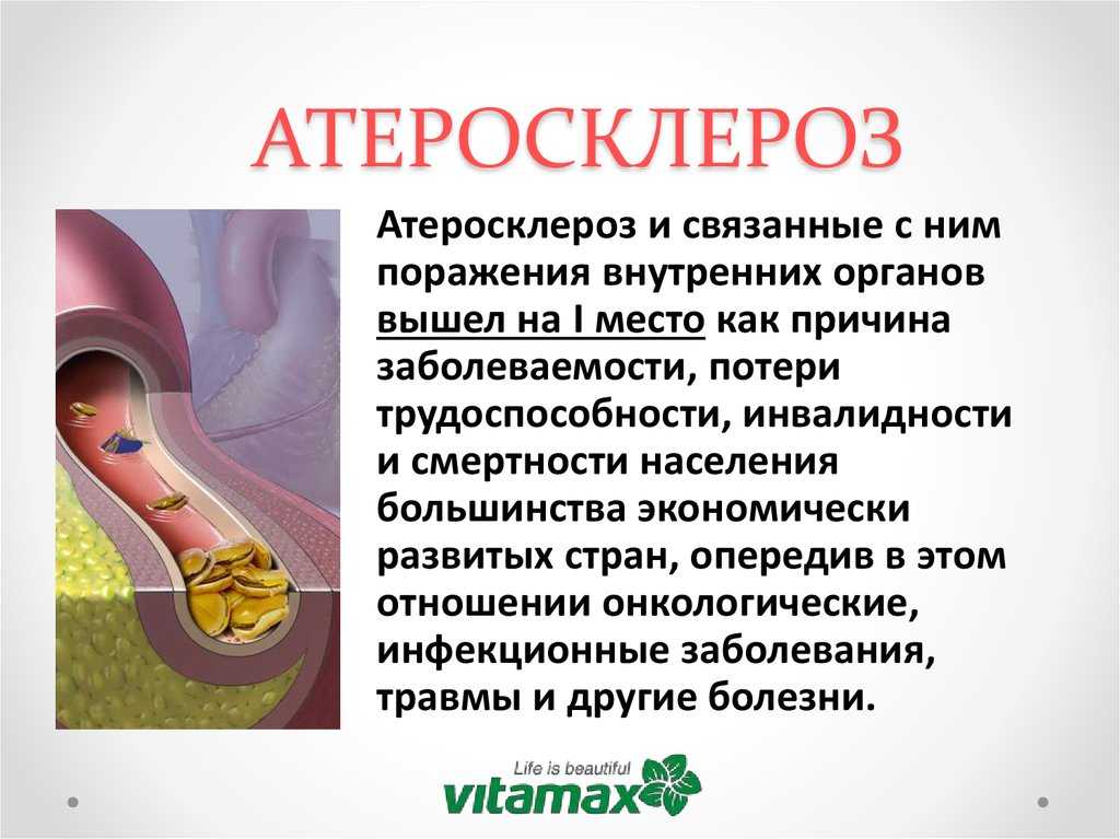 Как лечить атеросклероз сосудов
