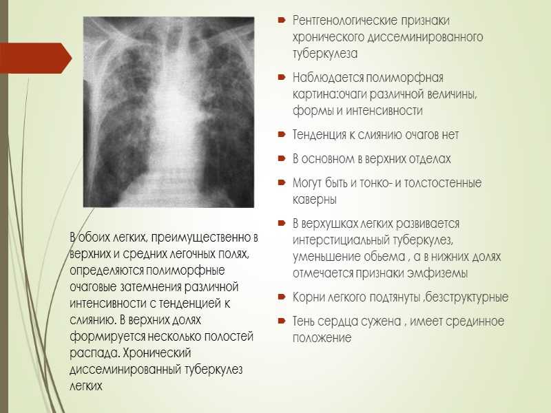 Сатурация при туберкулезе