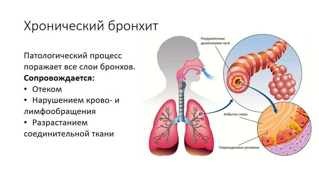 Хронический бронхит