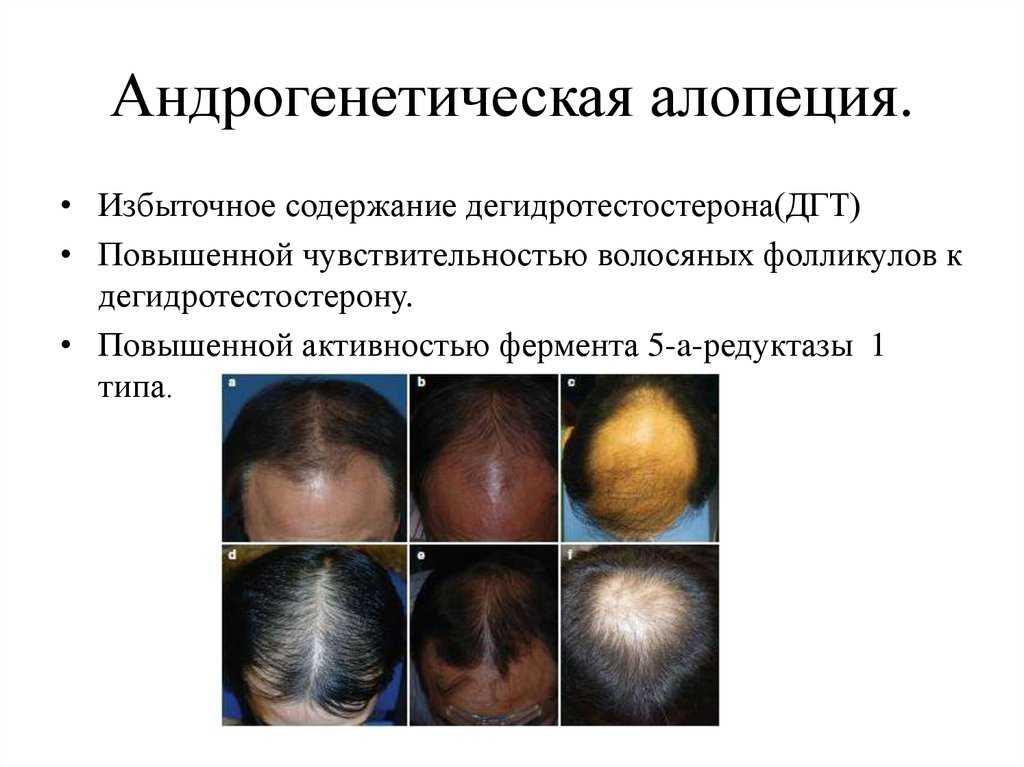Выпадение волос у женщин: причины и лечение | университетская клиника