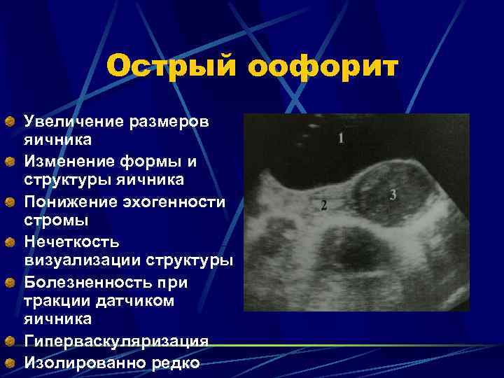 Воспаление яичников у женщин лечение. Хронический сальпингит УЗИ. Острый оофорит на УЗИ. Воспаление яичников на УЗИ.