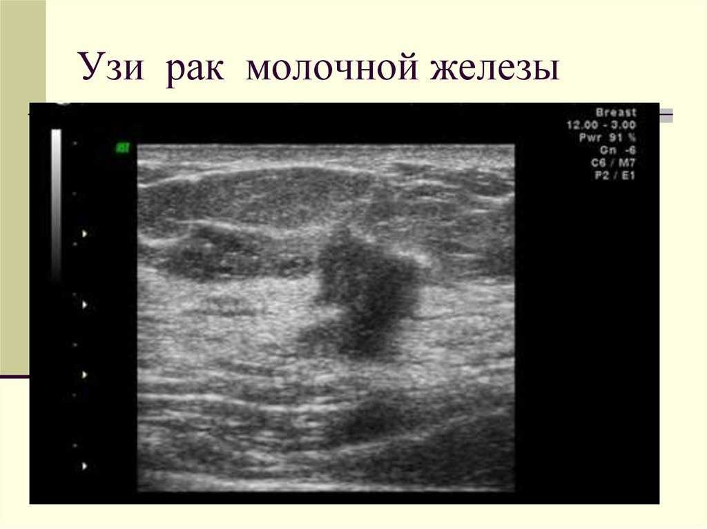 Узи при фиброаденоме, кисте, папилломе и раке молочной железы