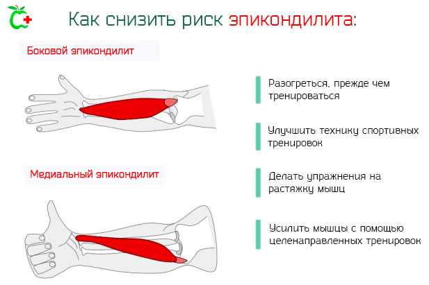 Протокол реабилитации (лечения) при медиальном эпикондилите (локоть гольфиста)