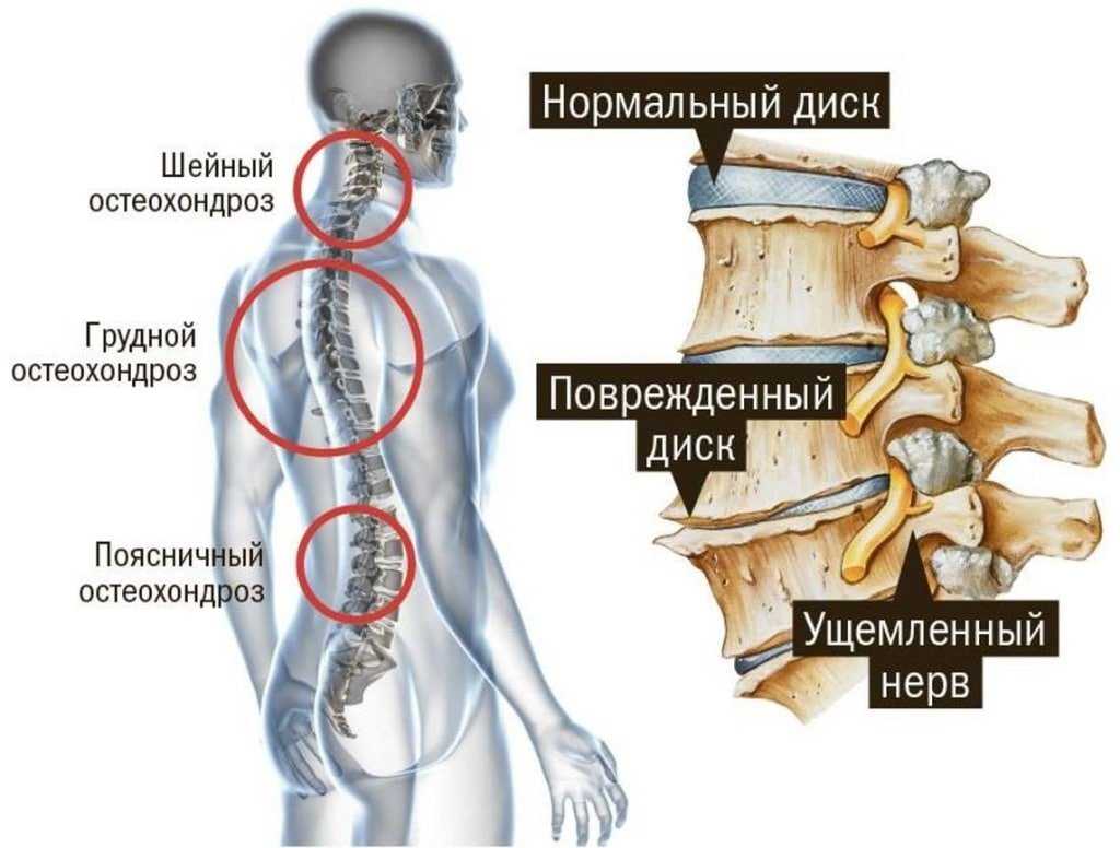 Боль в спине в области поясницы - 5 советов как избавиться от боли!