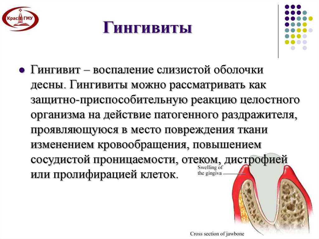 Воспаление десен: причины, лечение и профилактика