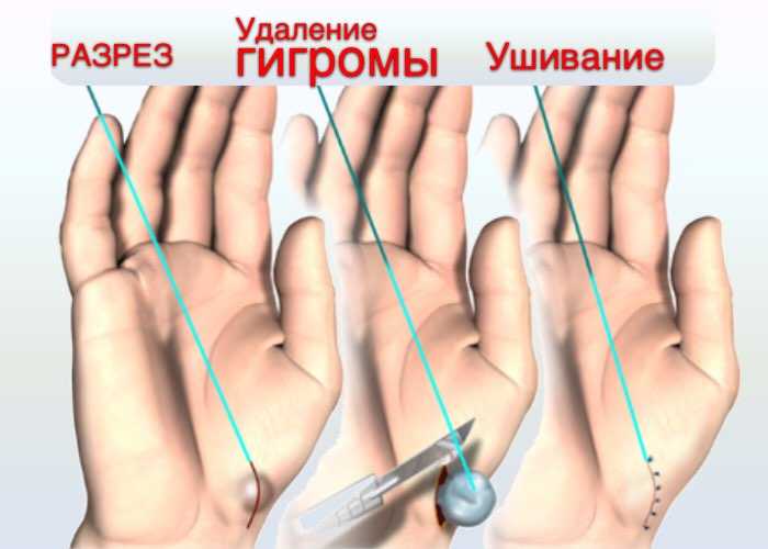Удаление гигром