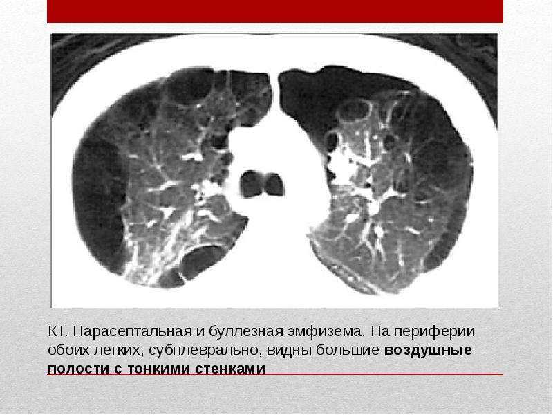 Эмфизема легких
