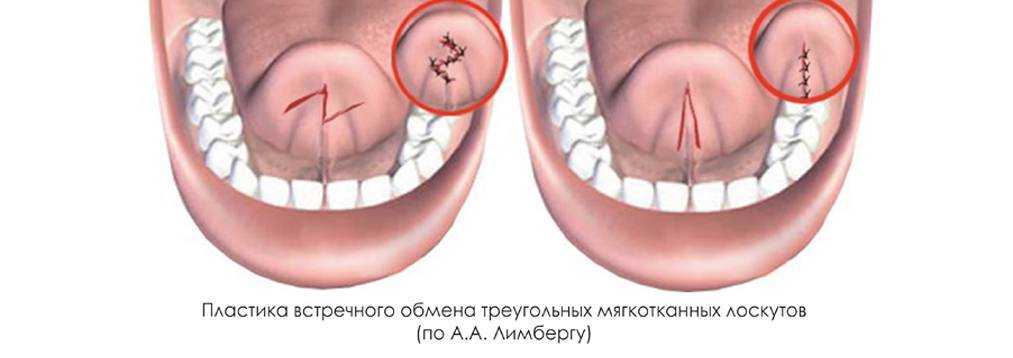 Пластика короткой уздечки * клиника диана в санкт-петербурге