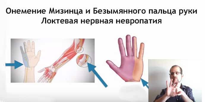 Онемения: конечностей – рук и ног, головы, лица и других частей тела
