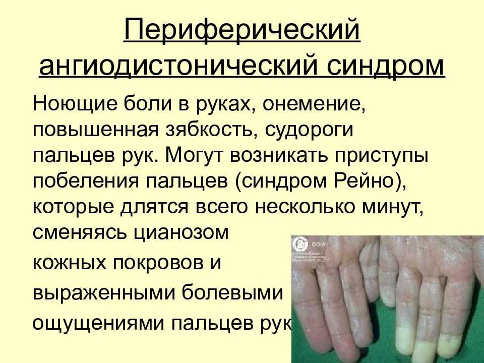 Синдром рейно | симптомы | диагностика | лечение - docdoc.ru