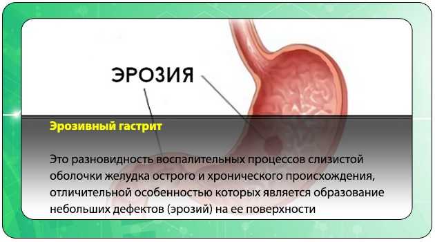 Гастрит желудка