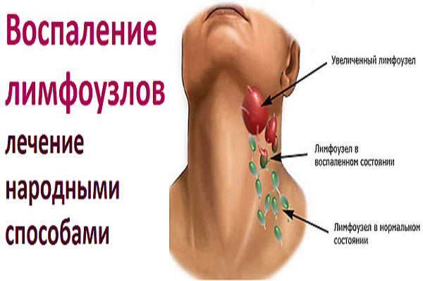 Острый тонзиллит - причины, симптомы, лечение