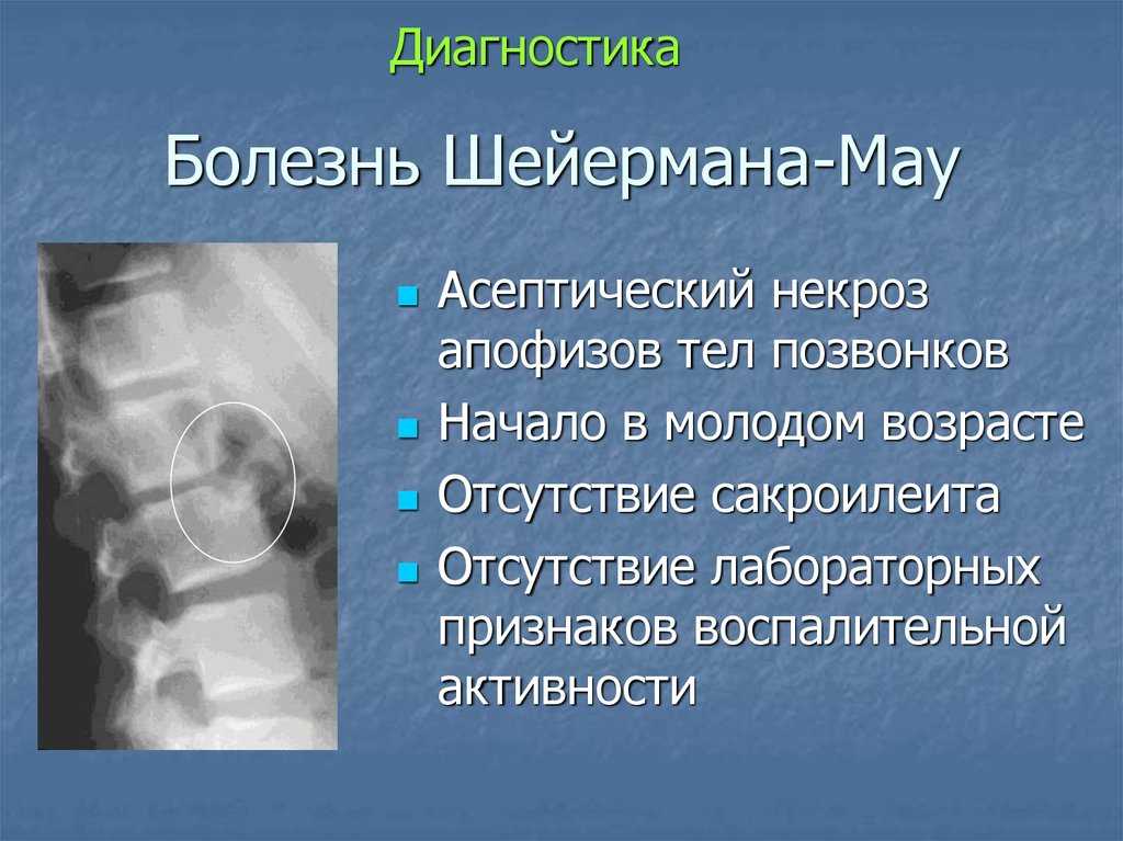 Кифоз