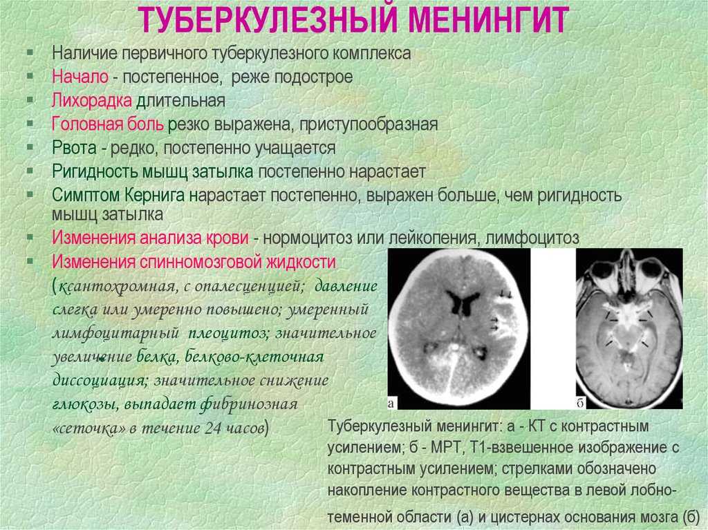 Менингококковый сепсис, или менингококцемия: симптомы у детей и взрослых, лечение, возможность выжить