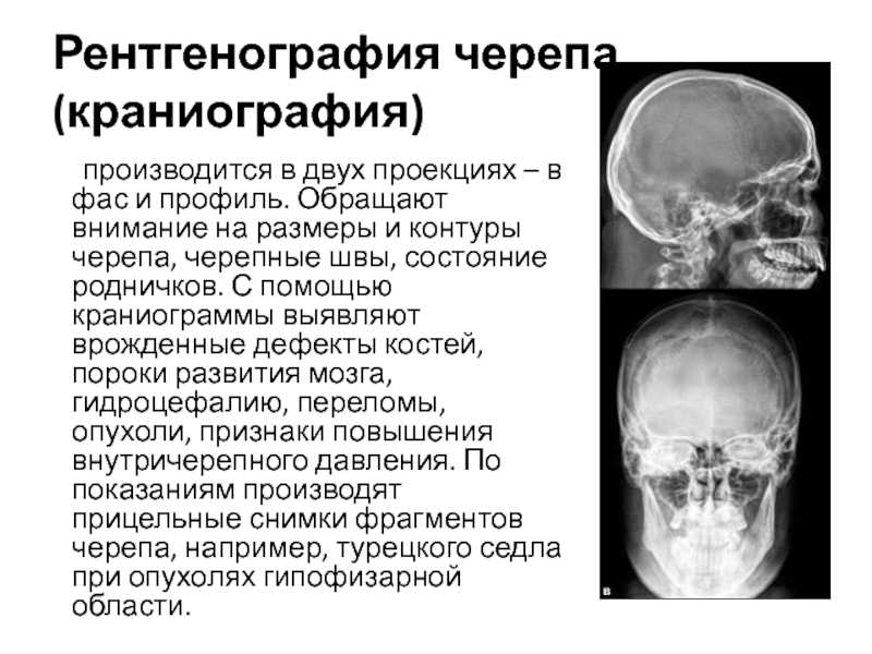 Рентген в двух проекциях. Рентген черепа в 2-х проекциях норма. Рентгенография черепа (краниография. Снимок черепа в боковой проекции норма. Рентген черепа прямая проекция норма.