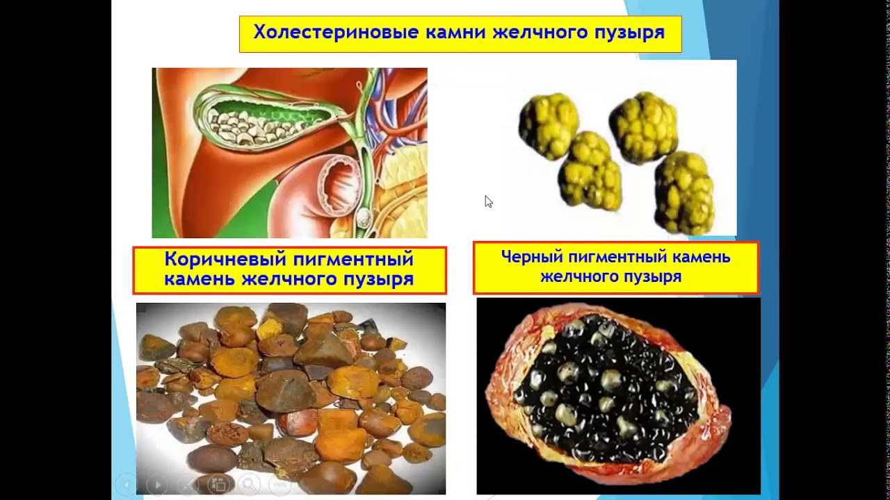 Лапароскопия желчного пузыря: показания и подготовка к операции | food and health