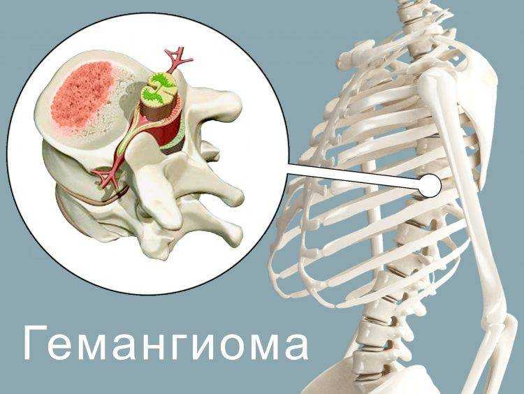 Кмн — гемангиома позвонка (вертебральная ангиома)