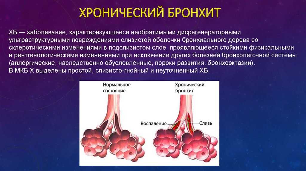 Бронхит — симптомы заболевания, профилактика и лечение бронхита