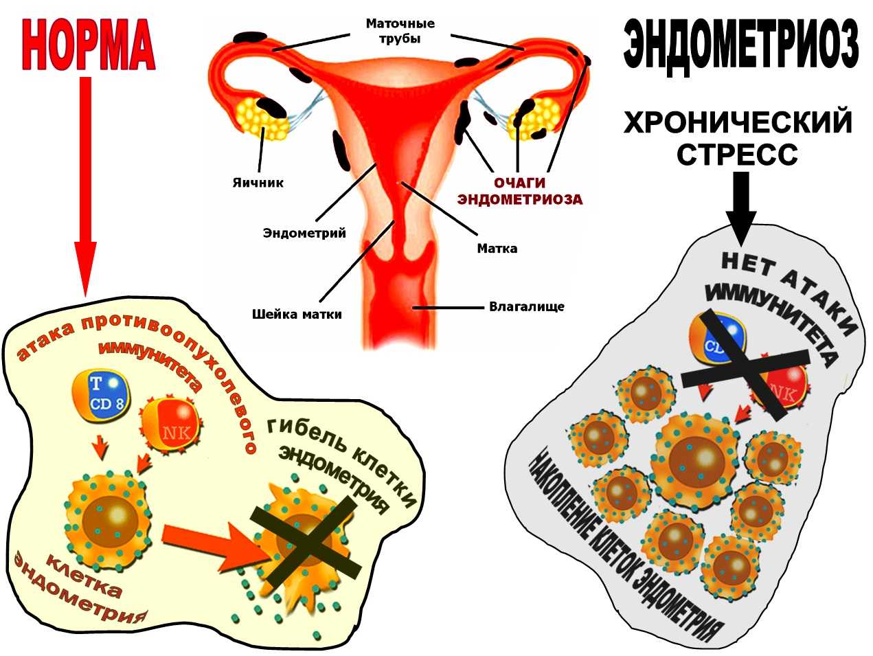 Причины эндометрии у женщин. Эндометриоз факторы риска. Эндометриоз факторы возникновения.