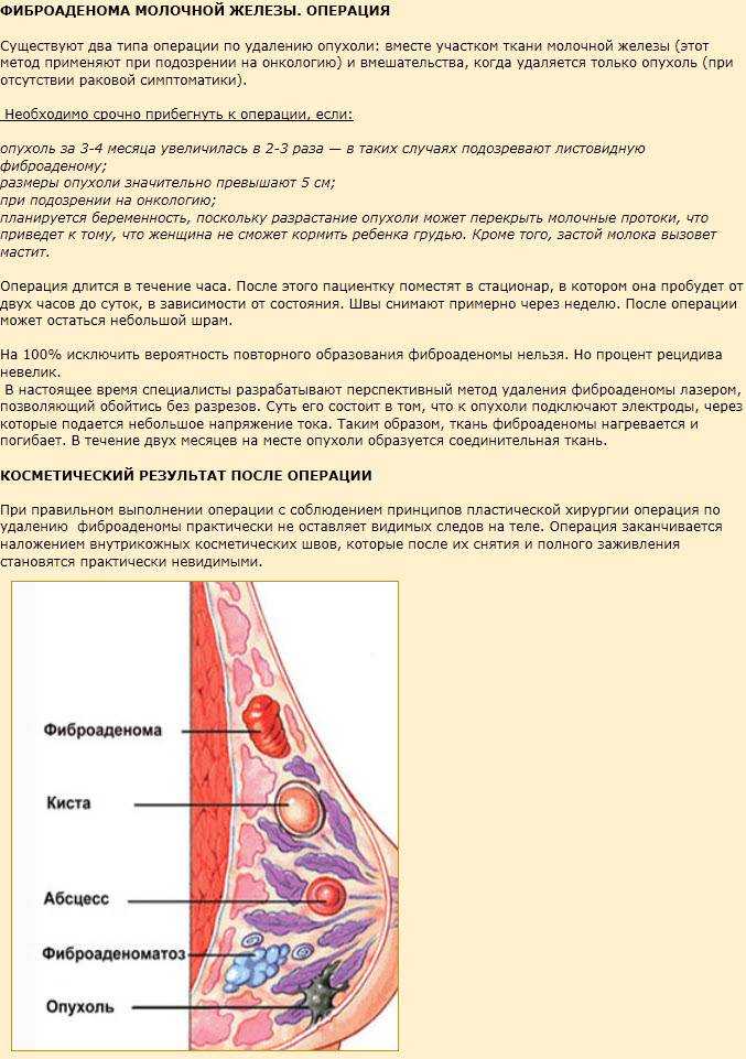Фиброаденома — насколько опасна эта опухоль в груди | evolutis clinic | дзен