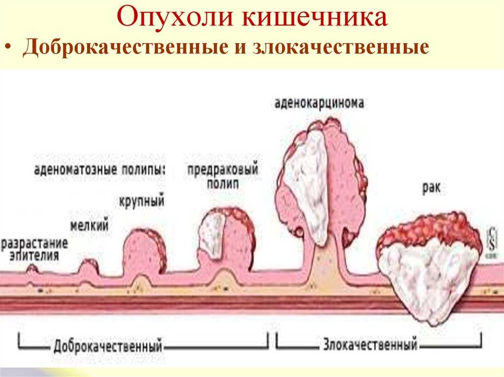Рак прямой кишки