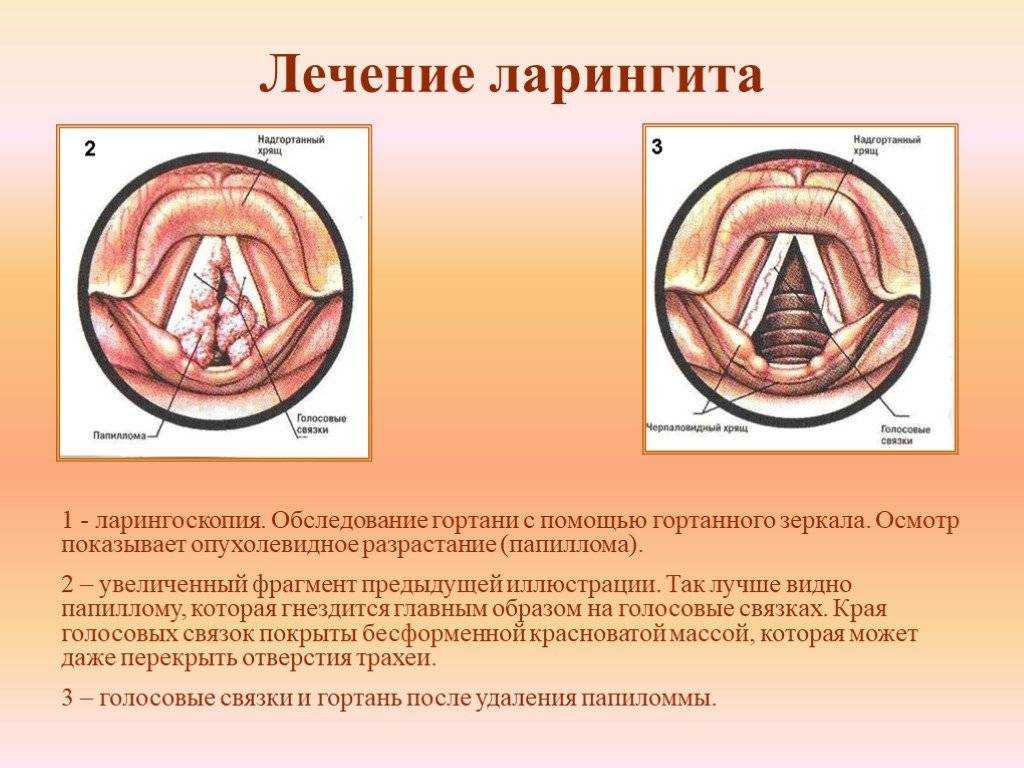 Ларингит схема лечения у детей