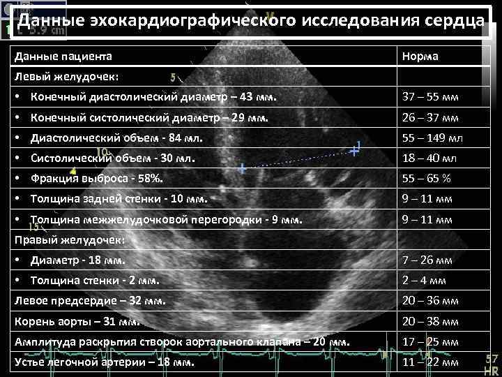 Эхокардиография сердца: принцип действия, возможности и показания к прохождению исследования