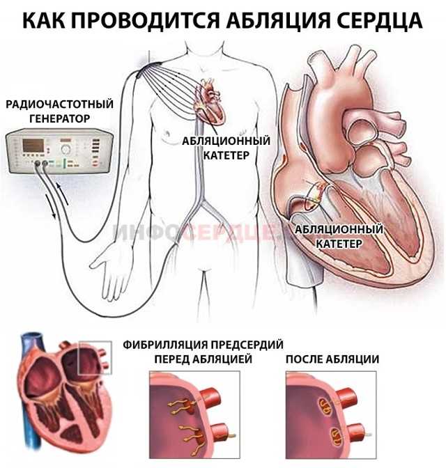 Операции на сердце