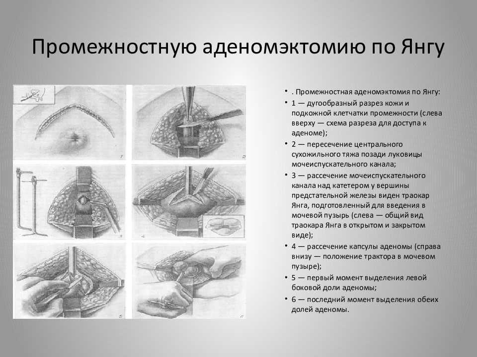 Удаление предстательной железы. Операции при гипертрофии предстательной железы. Радикальная простатэктомия. Лапароскопическая простатэктомия ход операции. Аденомэктомия операция.