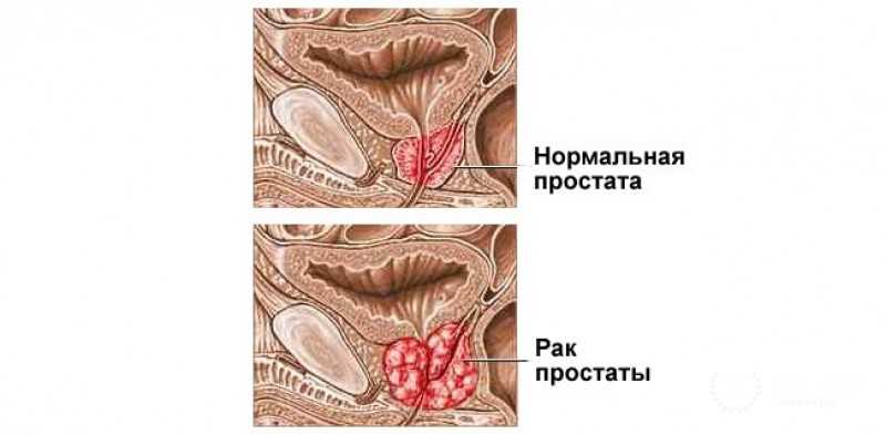 Рак простаты (предстательной железы) – напоправку
