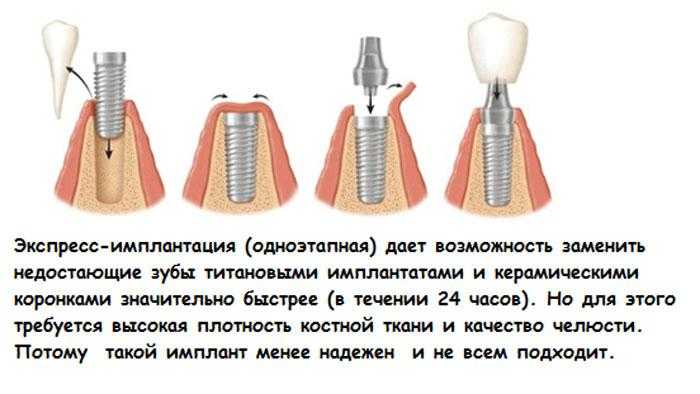 Имплантация схема установки зубов