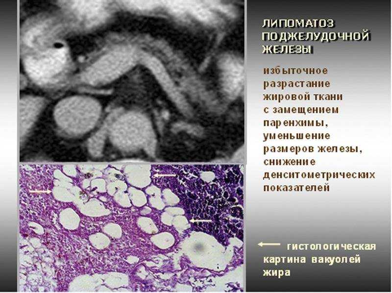 Поджелудочная железа фиброзные изменения. Липоматоз поджелудочной железы патанатомия. Липоматоз поджелудочной железы на УЗИ. Инволюция поджелудочной железы кт.