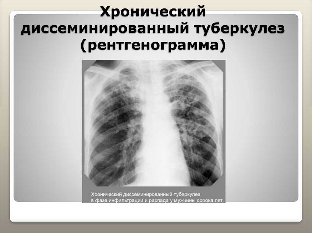 Туберкулёз на кт виден ли - кт, флюорография или рентген