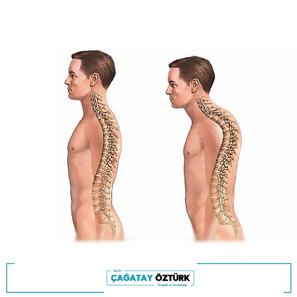 Что такое кифоз? 