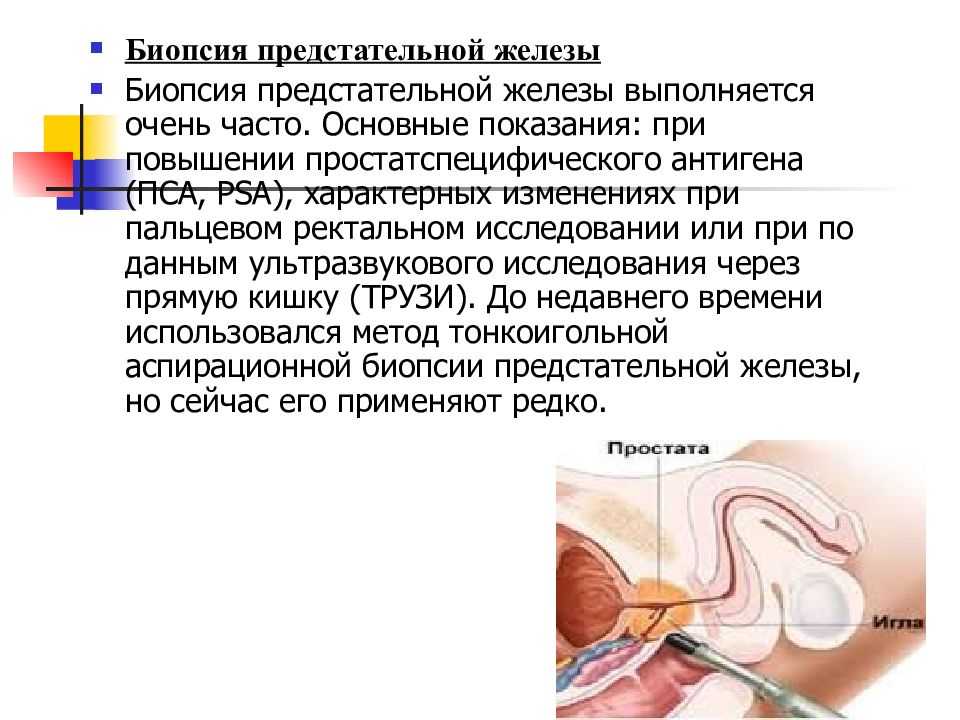 Биопсия простаты
