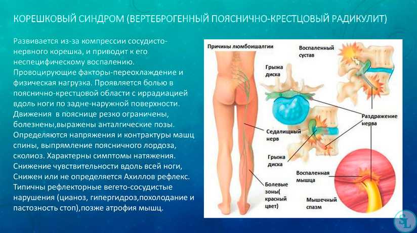 Парестезия