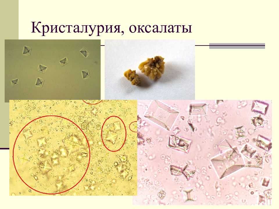 Соли ураты в моче - что это значит, причины и диета
