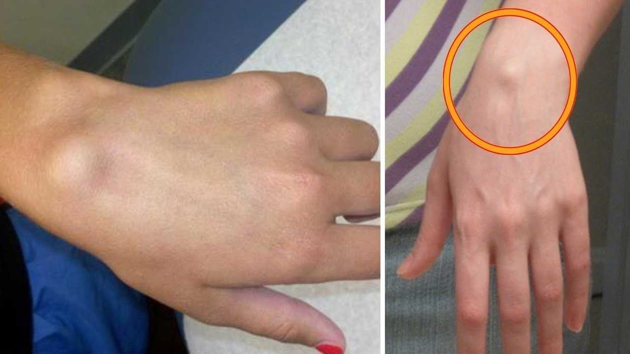 Что такое гигрома, причины появления и как ее лечить?