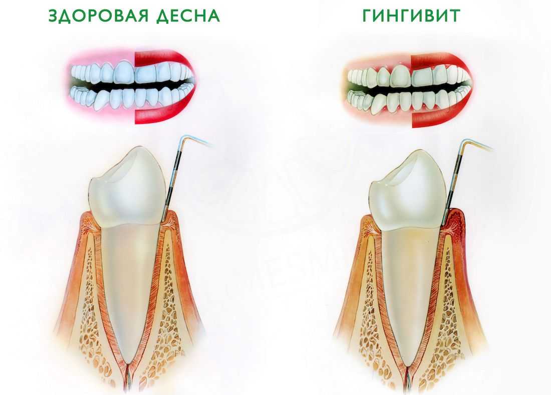 Хронический гингивит