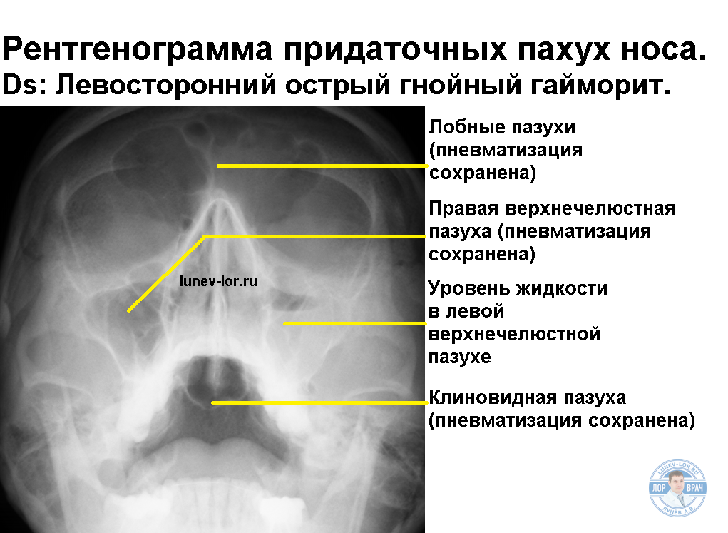 Верхнечелюстной синусит презентация