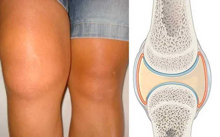 Лечение синовита коленного сустава